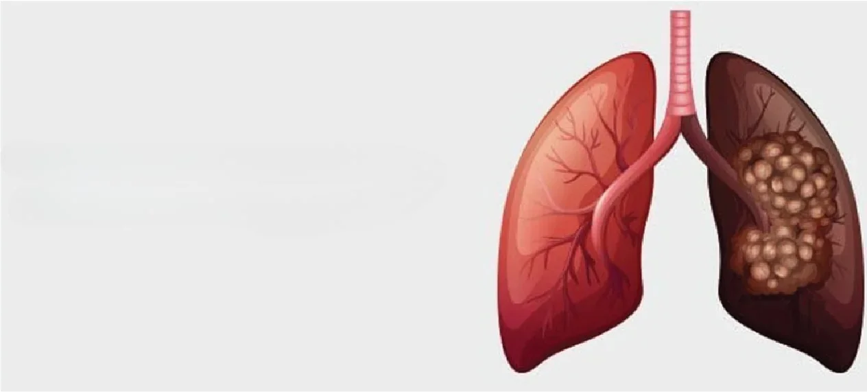 What is Lung Cancer and how can we prevent it